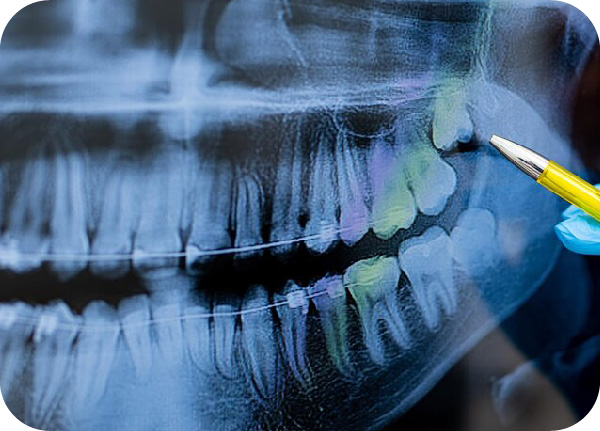 Bölcsességfog eltávolítása