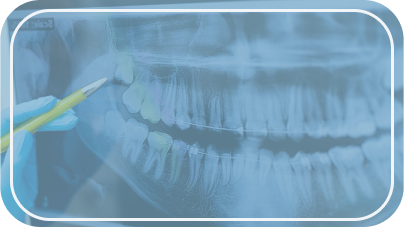 Bölcsességfog eltávolítása